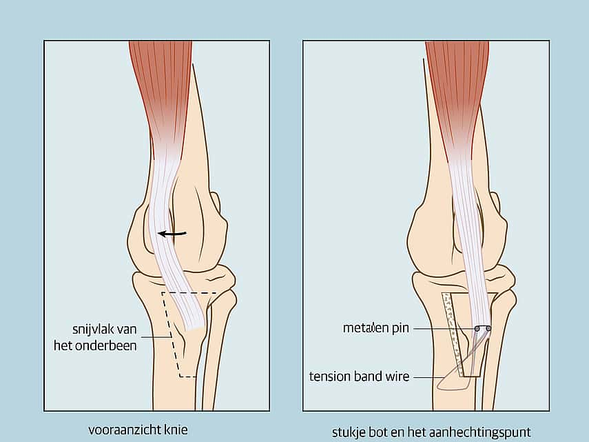 Patella luxatie vooraanzicht