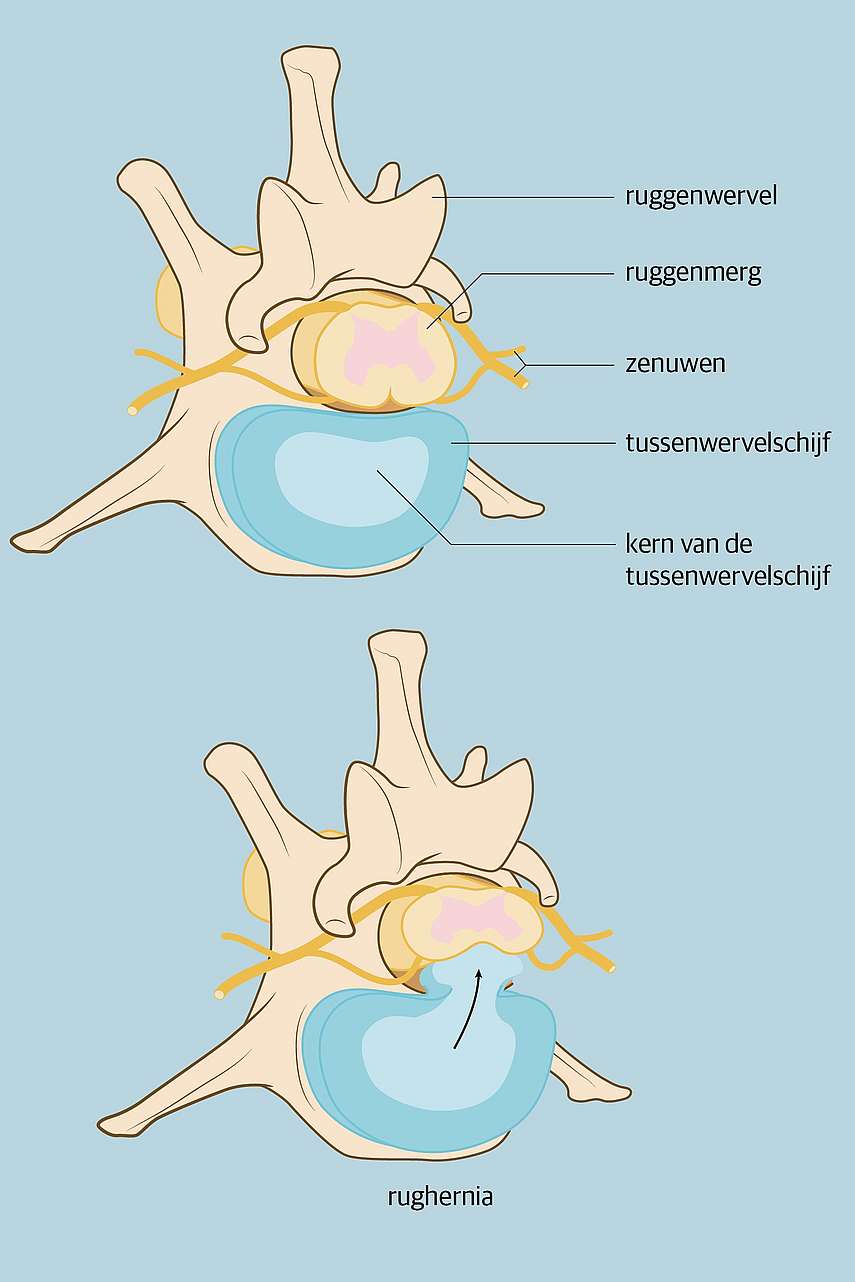 Rughernia