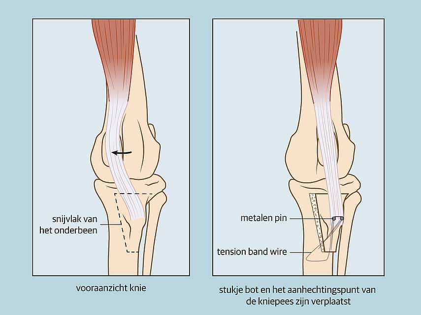 Patella luxatie operatie