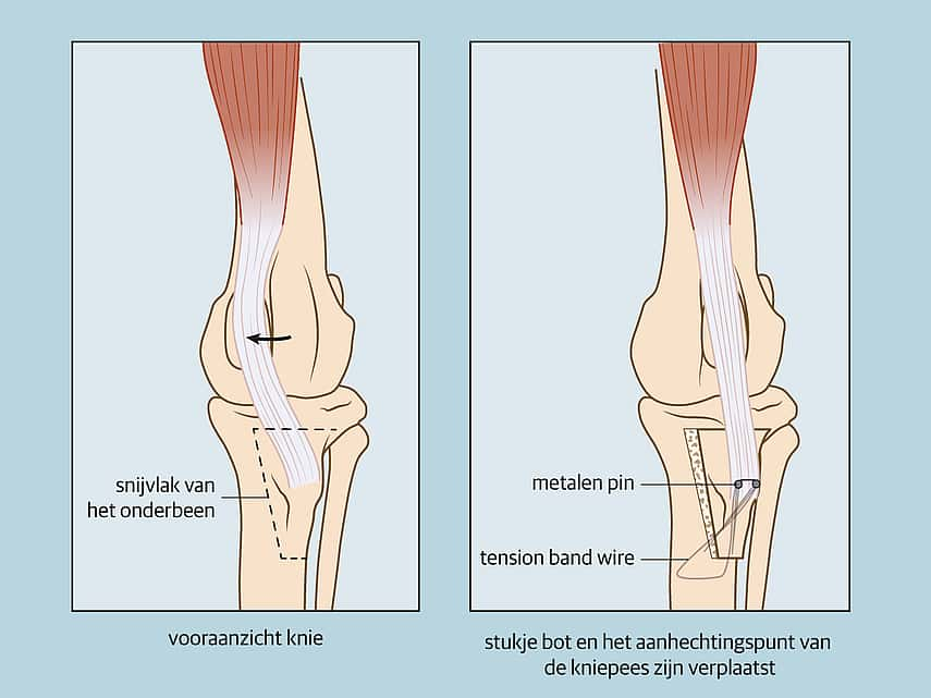 Patella luxatie operatie