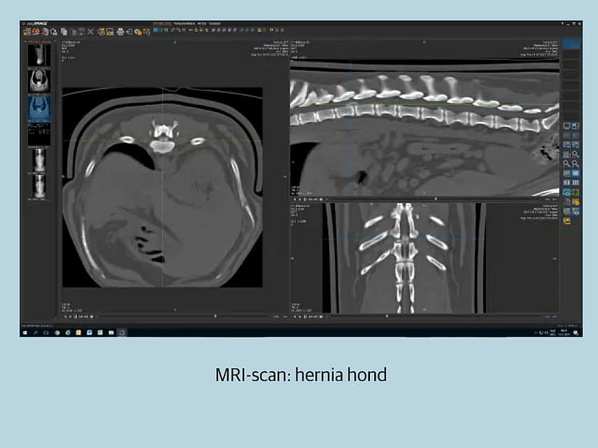 MRI hernia