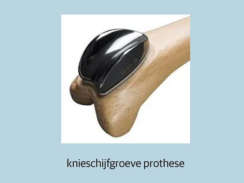 Knieschijfgroeve prothese