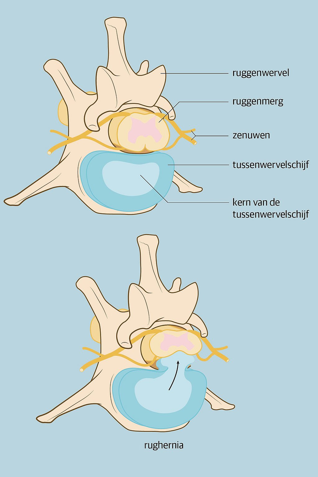 Een diagram van een Huperson-wervelkolom.