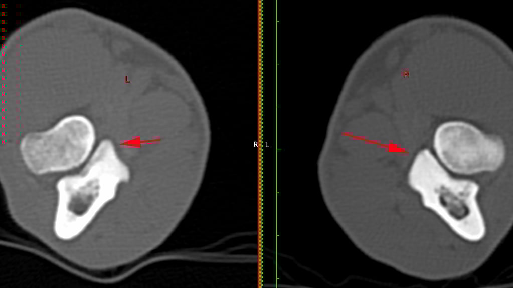 Een vergelijking van een CT-scan.