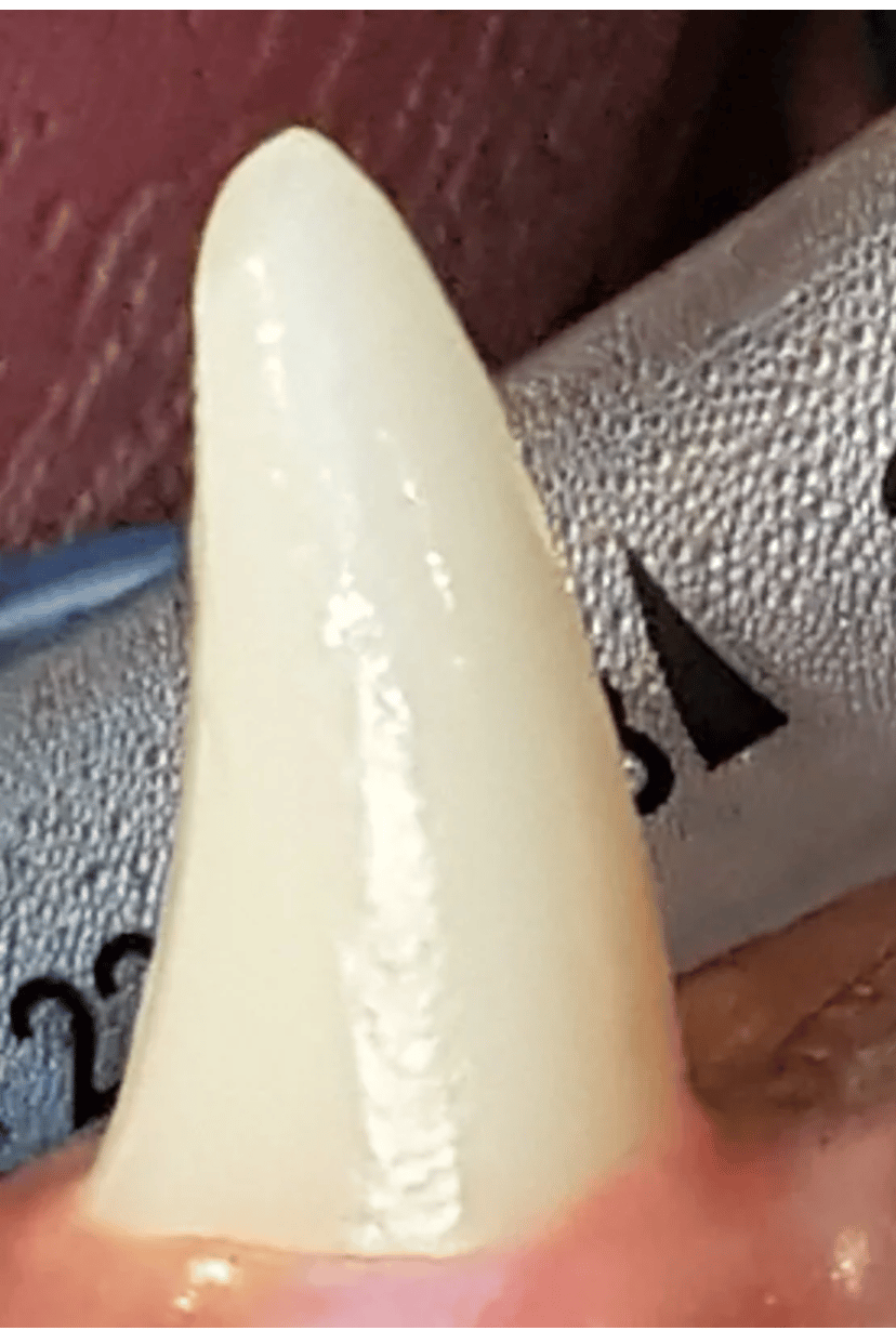 Een close-up van een tand.