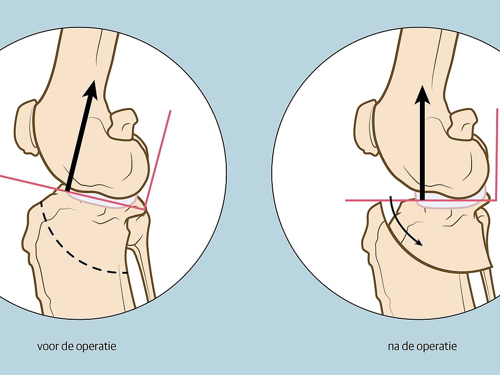 Een diagram van een kniegewricht.