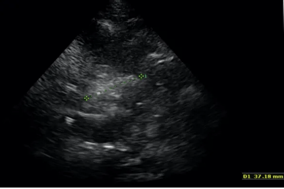 Een echografisch beeld van een baby.