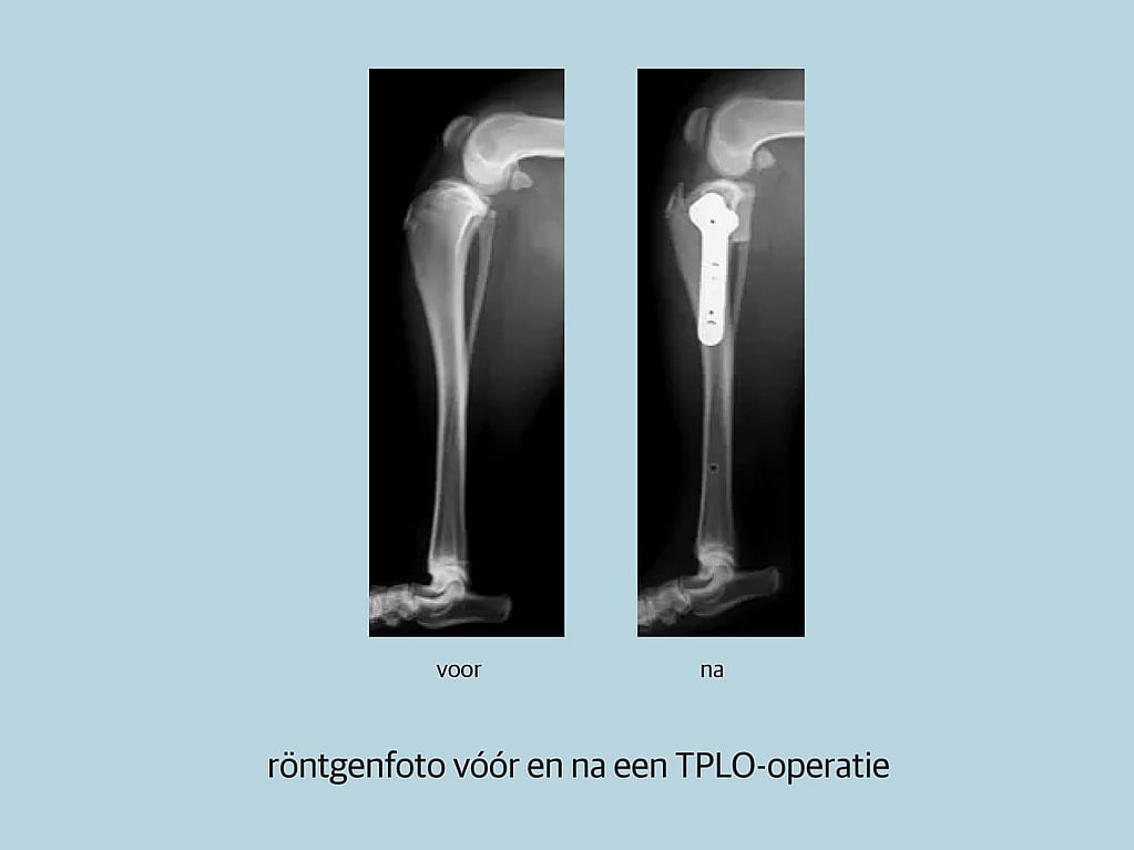 Röntgenfoto van een gebroken been.