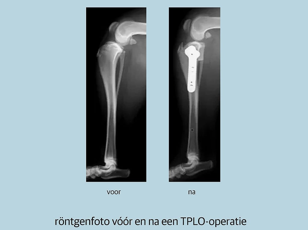 Röntgenfoto van een gebroken been.