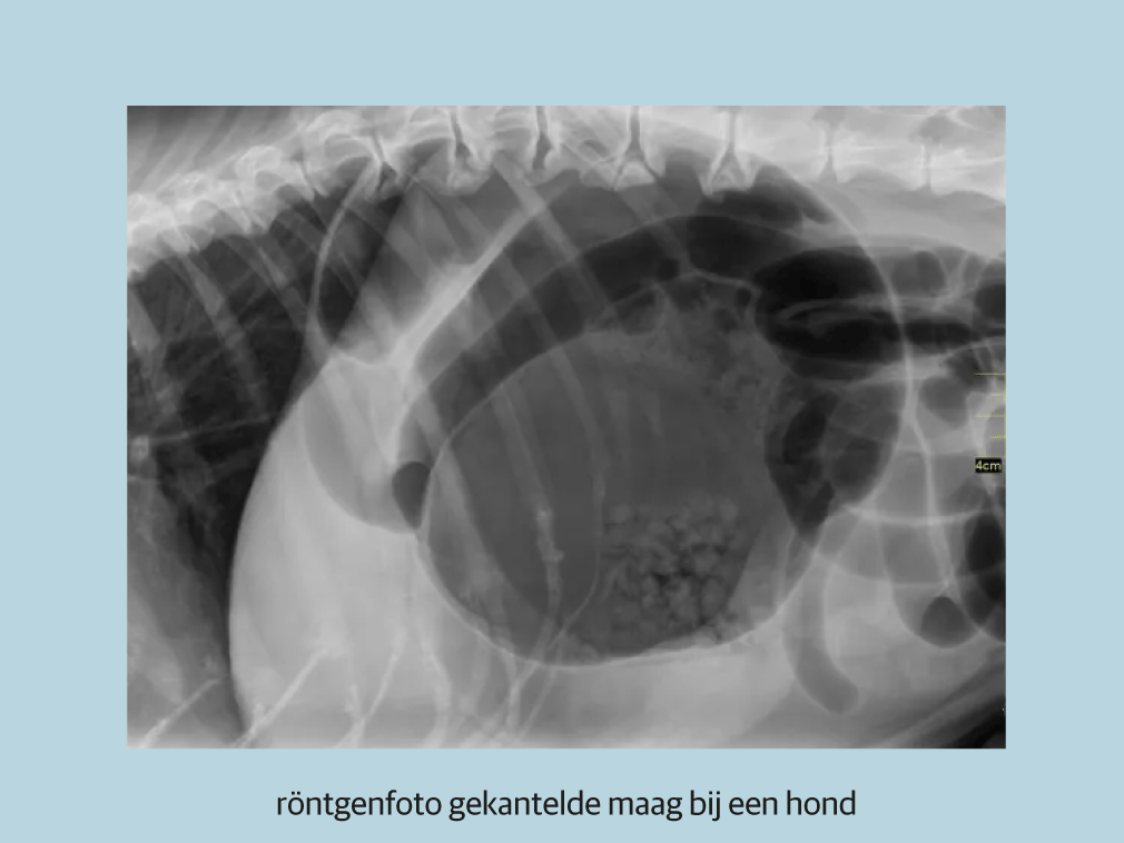Een röntgenfoto van de borst van een persoon.