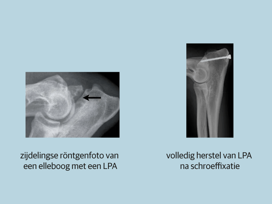 Röntgenstraal van een bot.