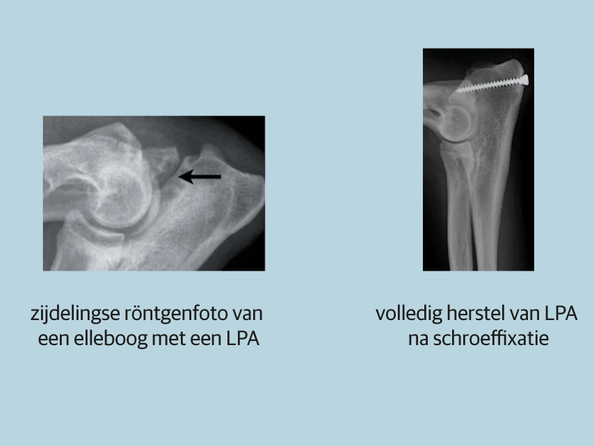 Röntgenstraal van een bot.