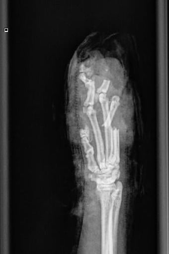 Röntgenstraal van een hand.