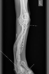 Röntgenstraal van een been met een gebroken been.