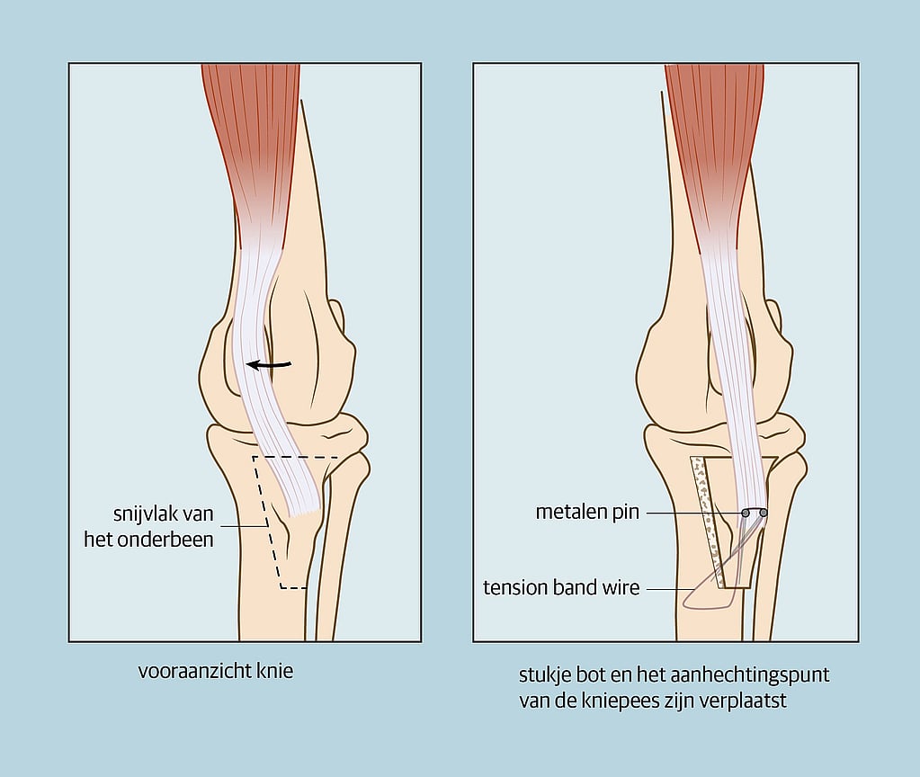 Een diagram van een kniegewricht.