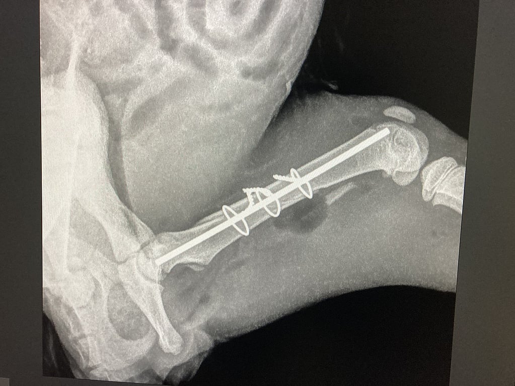 Röntgenstraal van een voet met een gebroken been.